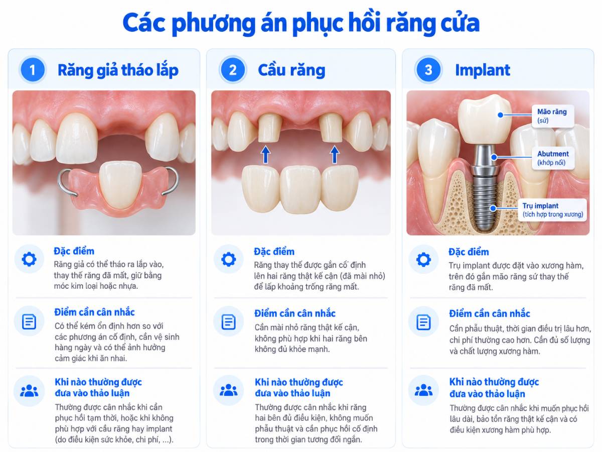 Răng giả tháo lắp, cầu răng và Implant là ba nhóm phương án thường được cân nhắc khi phục hồi răng cửa.